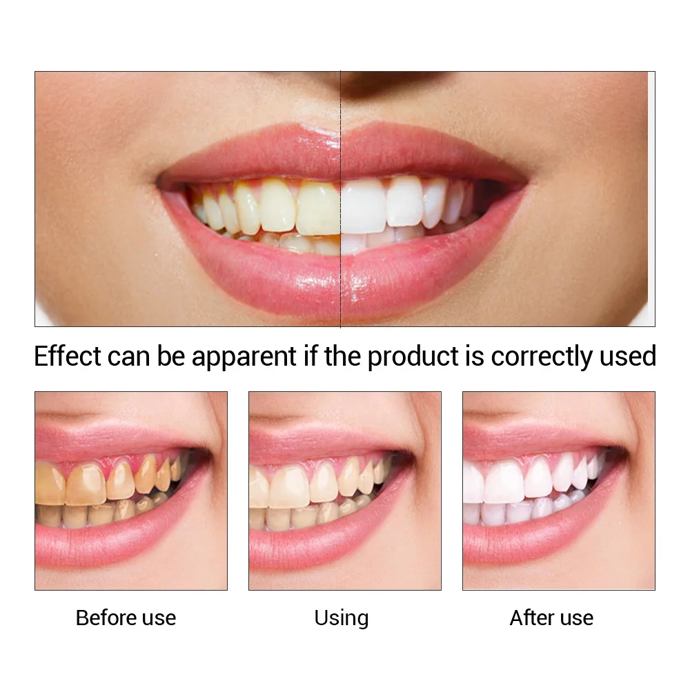 FTEENPLY ฟันไวท์เทนนิ่ง Oral ส - Teeth Whitening Near Me บทวิจารณ์และราคา