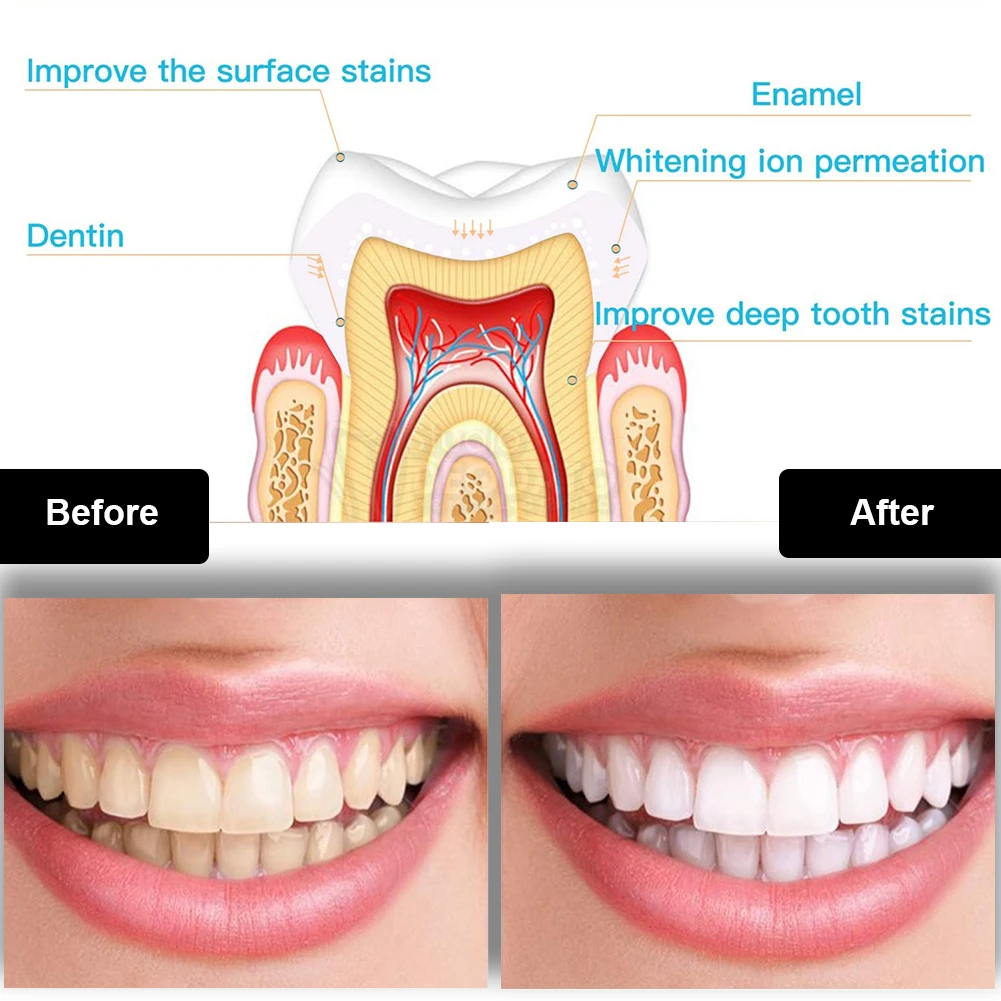 ทันตกรรมชุดฟอกสีฟัน Mini 16 LE - Teeth Whitening Pens บทวิจารณ์และราคา